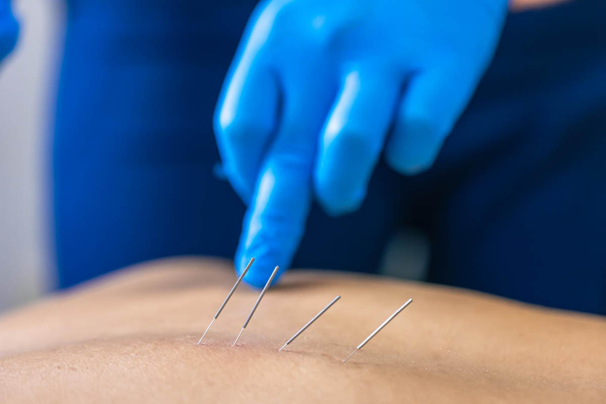 Dry Needling Treatment Fishers, IN A Comprehensive Guide to Relief and Recovery