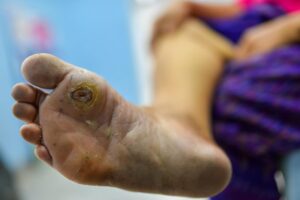 Orthopedic Treatment for Diabetic Gangrene Comprehensive Approaches to Protect Limbs and Improve Outcomes