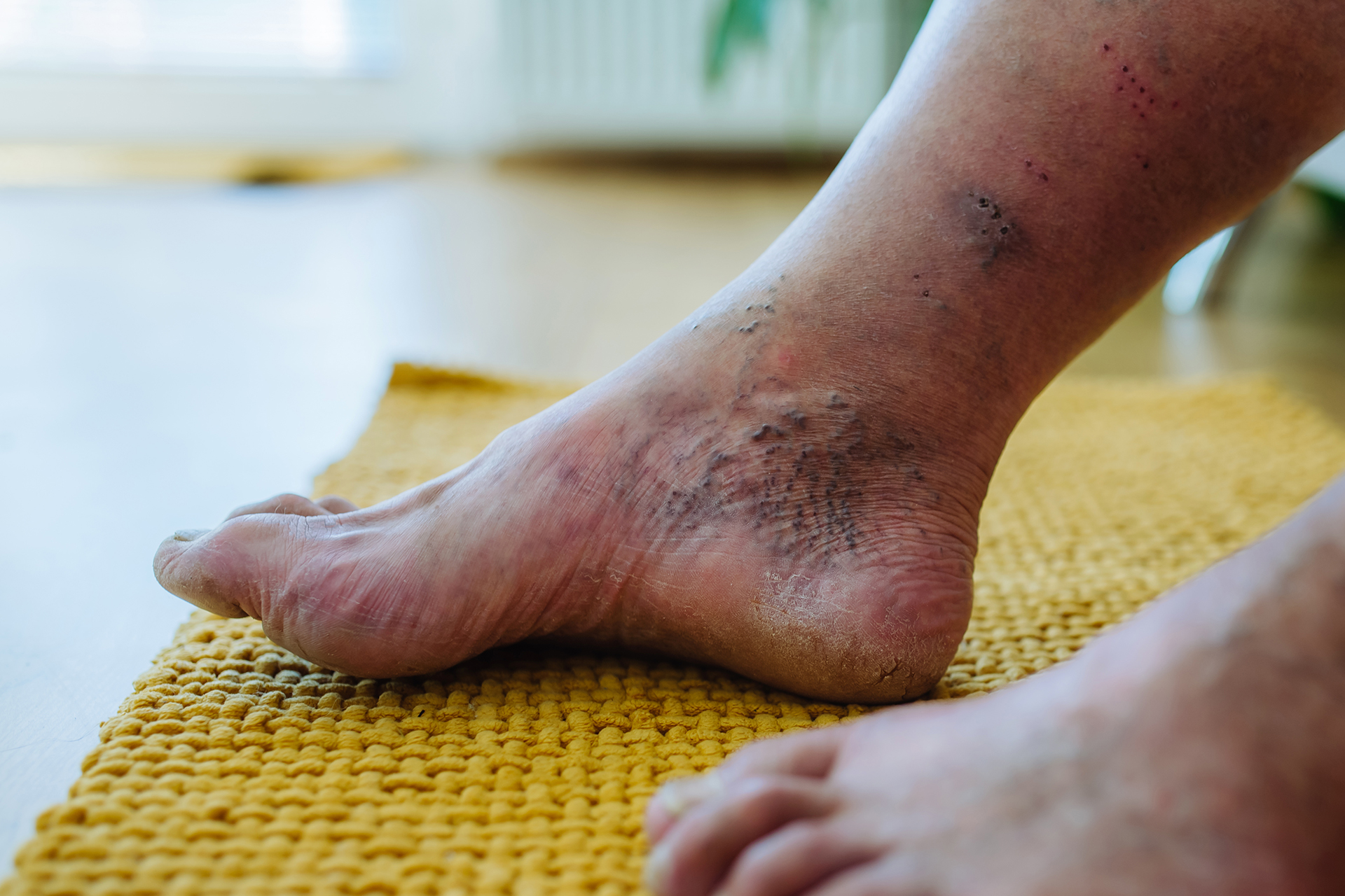 Comprehensive Diabetic Foot Ulcer Management Effective Strategies, Treatments, and Prevention